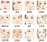 做激光祛斑后結(jié)痂多久脫落？