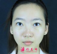 北京八大處靳小雷隆鼻效果怎么樣？看真人案例可參考!