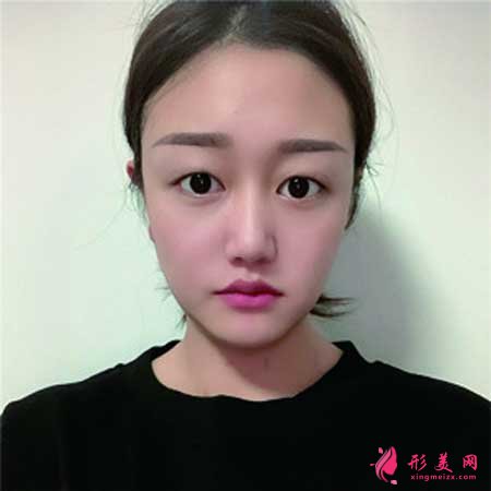 找八大處宗憲磊醫(yī)生做了雙眼皮手術(shù)，術(shù)后6個(gè)月恢復(fù)效果圖