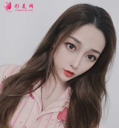 去北京麗都找曹衛(wèi)華醫(yī)生做鼻綜合整形手術(shù)后30天