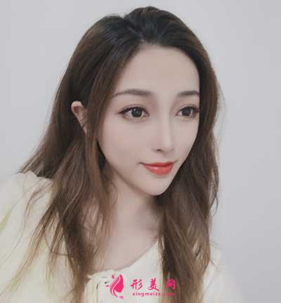 去北京麗都找曹衛(wèi)華醫(yī)生做鼻綜合整形手術(shù)后兩個月