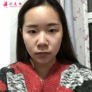 去成都華美紫馨找陳楊做全切雙眼皮，術后70天恢復效果對比圖