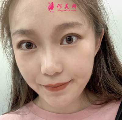 去河南整形美容醫(yī)院找聶麗麗醫(yī)生做眼綜合整形手術后1個月