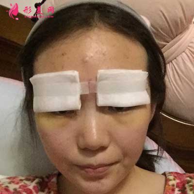 去河南整形美容醫(yī)院找聶麗麗醫(yī)生做眼綜合整形手術后第1天