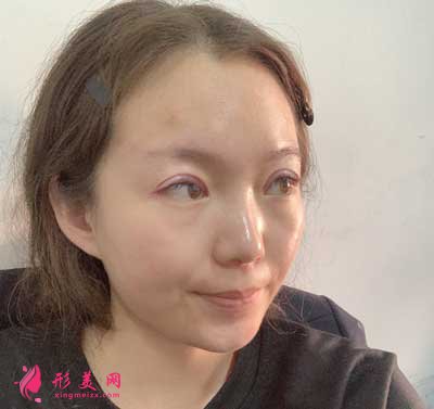 去河南整形美容醫(yī)院找聶麗麗醫(yī)生做眼綜合整形手術后7天