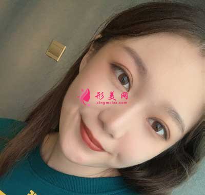 去河南整形美容醫(yī)院找聶麗麗醫(yī)生做眼綜合整形手術后50天