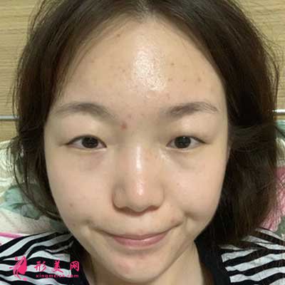 去河南整形美容醫(yī)院找聶麗麗醫(yī)生做眼綜合整形手術前
