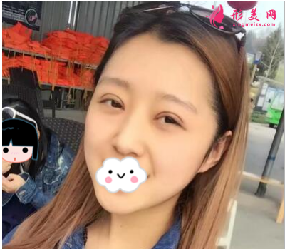 上海百達麗整形王維做雙眼皮怎么樣？60天術(shù)后效果對比真的好極了