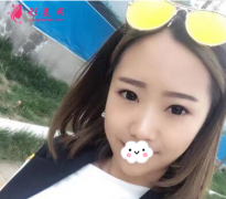 上海百達(dá)麗整形醫(yī)院做雙眼皮怎么樣？60天術(shù)后效果對(duì)比真的好極了