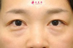 眼袋明顯應(yīng)該如何做消除？