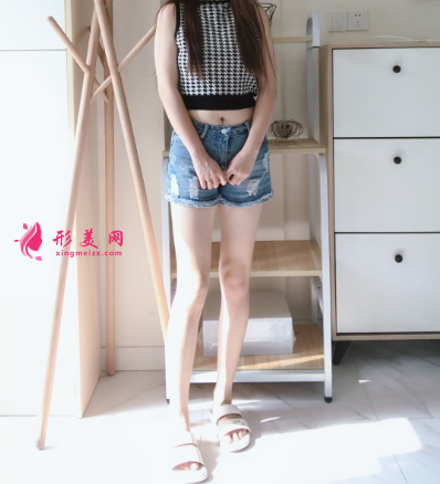 上海瑞芙臣整形醫(yī)院馬昌華大腿吸脂案例