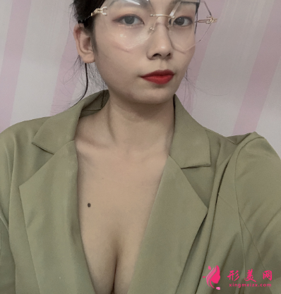 上海港華整形醫(yī)院呂金陵豐胸案例 上海港華整形醫(yī)院呂金陵豐胸案例