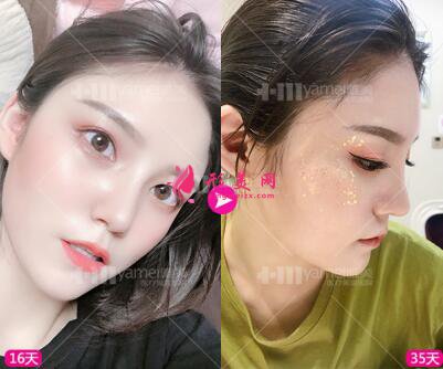 長沙雅美田芳斌做的鼻綜合