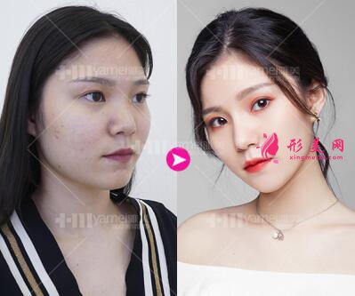 長沙雅美田芳斌做的鼻綜合