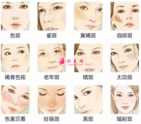 廣州美萊激光祛斑要多少錢(qián)呢？