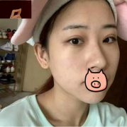 我找西安畫美余克峰院長做了全臉的脂肪填充90天術(shù)后記錄