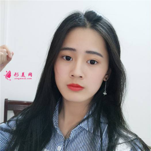 理想中的自己的整形術(shù)后圖片