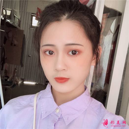 理想中的自己的整形術(shù)后圖片