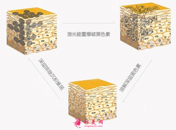激光治療雀斑對(duì)皮膚有損傷嗎