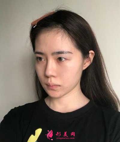 孫峰醫(yī)生雙眼皮案例