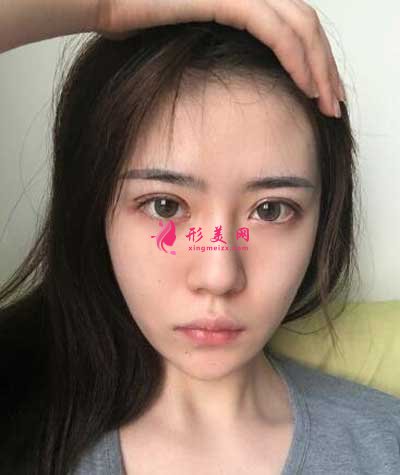 孫峰醫(yī)生雙眼皮案例