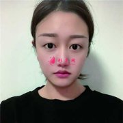 北京八大處做了雙眼皮手術(shù)，術(shù)后6個月恢復(fù)效果圖