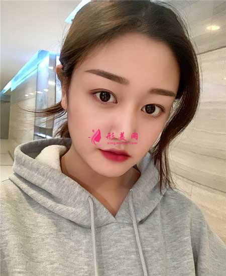 找八大處宗憲磊醫(yī)生做了雙眼皮手術，術后6個月恢復效果圖