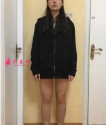 廣州星團(tuán)整形醫(yī)院做了吸脂瘦大腿,終于瘦下來了