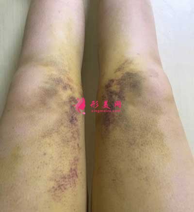 去廣州星團(tuán)找趙輝做了吸脂瘦大腿手術(shù)后第3天