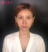黑眼圈如何去除？填充玻尿酸淚溝+黑眼圈解決