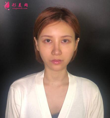 黑眼圈如何去除？填充玻尿酸淚溝+黑眼圈一步解決