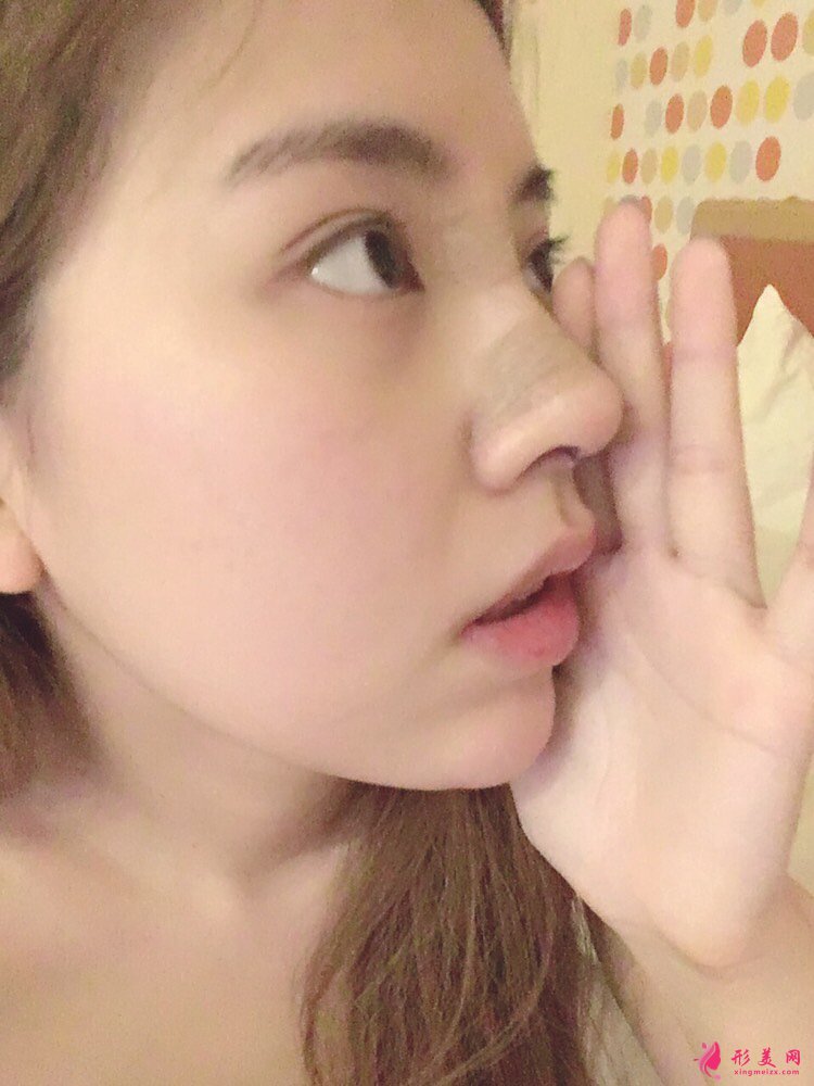 鼻頭鼻翼縮小手術(shù)案例，術(shù)后恢復(fù)全記錄！