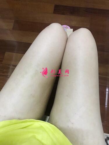 北京自體脂肪隆胸術(shù)案例，術(shù)后4個(gè)月恢復(fù)過程！
