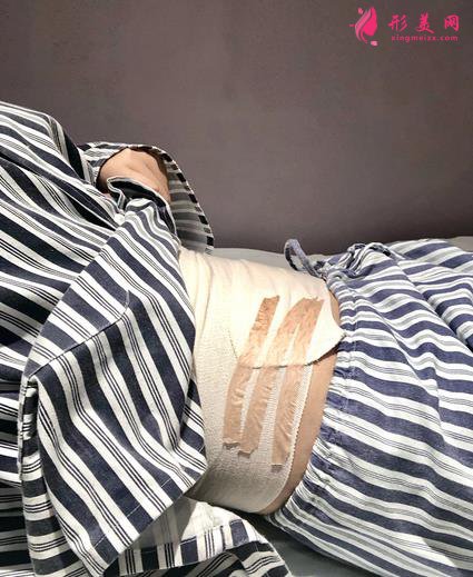 胖妞變型記：腰部吸脂術(shù)術(shù)后恢復(fù)全過程，看我72變~