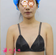 上海美侖整形醫(yī)院假體隆胸案例 我也能擁有性感大酥胸啦