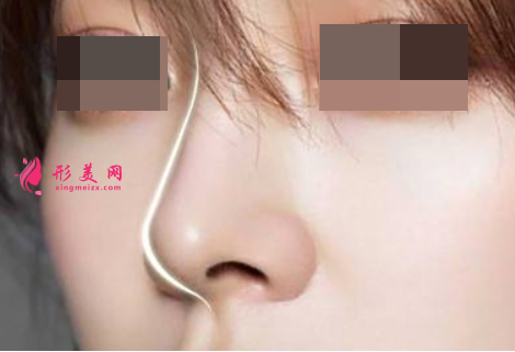 膨體隆鼻后要多久消腫