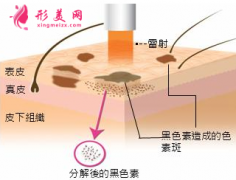 美萊王溪濤做激光祛斑如何？