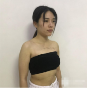 北京八大處隆胸案例圖分享，終于可以挺胸抬頭做女人了！