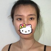 煙臺(tái)華美整形醫(yī)院雙眼皮+開眼角案例，您心動(dòng)了嗎？