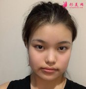 北京中日友好醫(yī)院整形外科磨骨案例分享，沒想過我能這么漂亮！