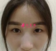 寧波尚麗姜艷做雙眼皮效果怎么樣？親生經(jīng)歷恢復(fù)效果圖供參考