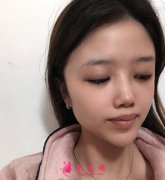 北醫(yī)三院整形外科雙眼皮全新案例效果圖分享，看技術(shù)口碑