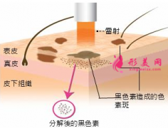 激光祛斑多少天可以洗臉？