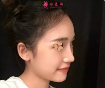 深圳福華整形醫(yī)院做的超體隆鼻效果圖，本人很喜歡！