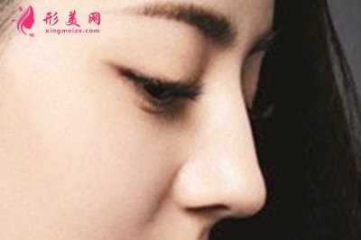 假體隆鼻后會(huì)鈣化嗎