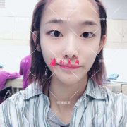 分享我找程宗玉做植發(fā)，術(shù)后效果簡直不要太好