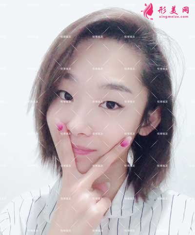 成都恒博植發(fā)術后7天圖片