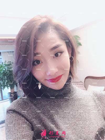成都恒博植發(fā)術后4天圖片
