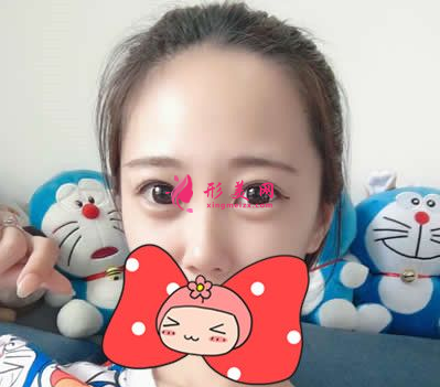 找武漢協(xié)和郭能強(qiáng)做的雙眼皮 術(shù)后60天效果真的超乎我的想象