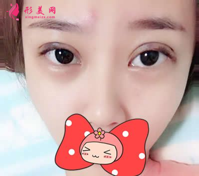 找武漢協(xié)和郭能強(qiáng)做的雙眼皮 術(shù)后60天效果真的超乎我的想象